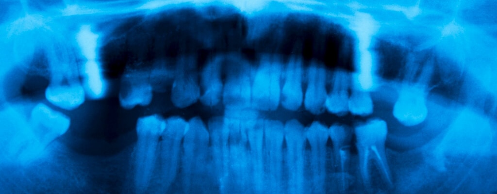 bone loss score may tip off doctors to gum disease